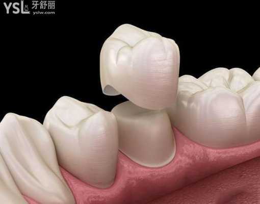 大牙带牙冠的过程图解（大牙带牙冠的过程图解图片）-图1