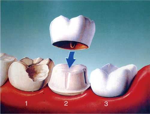 大牙带牙冠的过程图解（大牙带牙冠的过程图解图片）-图2