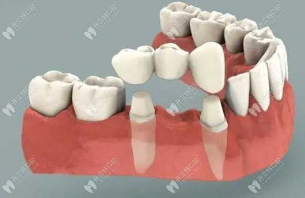大牙带牙冠的过程图解（大牙带牙冠的过程图解图片）-图3