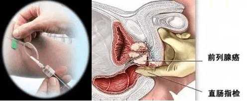 前列腺检查全过程视频（前列腺检查全过程视频讲解）-图1