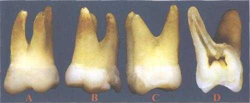 排牙过程（排牙过程中上颌第一磨牙的位置及具体要求）-图3