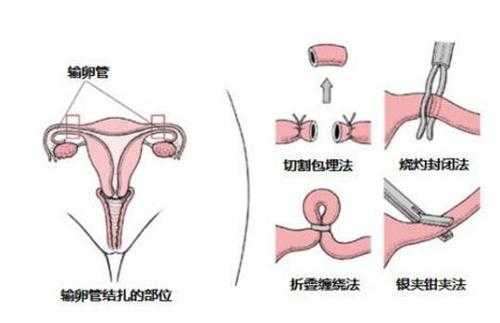 女性结扎图片过程（女性结扎的原理图）-图1