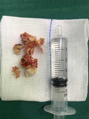 胆脂瘤手术过程（胆脂瘤手术流程）-图3
