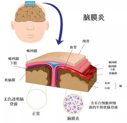 儿童脑膜脑炎恢复过程（儿童脑膜炎后遗症的表现）-图3