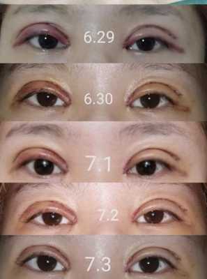 平行式双眼皮恢复过程中（平行双眼皮术后）-图2