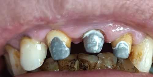 口腔金属桩过程（牙金属桩好取出来吗）-图1