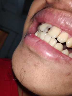 门牙补牙过程图（门牙补牙齿）-图2