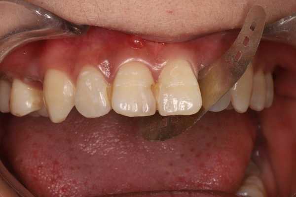 门牙补牙过程图（门牙补牙齿）-图3