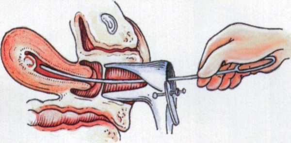 什么是刮宫手术过程（什么叫刮宫手术）-图1