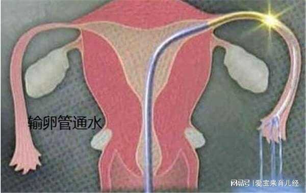 输卵管通水全过程（输卵管通水术怎么做的）-图1