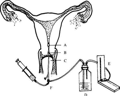 输卵管通水全过程（输卵管通水术怎么做的）-图2