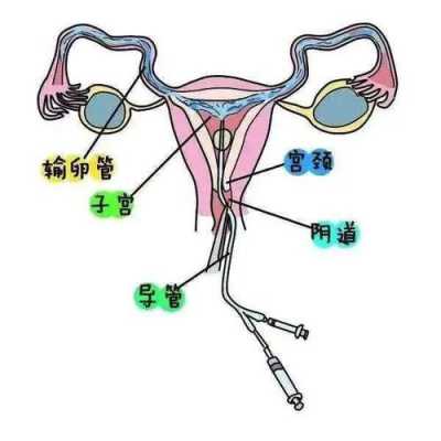 输卵管通水全过程（输卵管通水术怎么做的）-图3