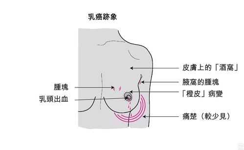 乳腺癌的病变过程（乳腺癌的病变过程图片）-图3