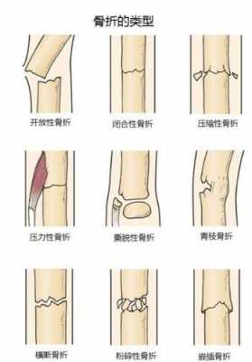骨折愈合过程中必须经过的过程（骨折愈合过程中必须经过的过程包括）-图2