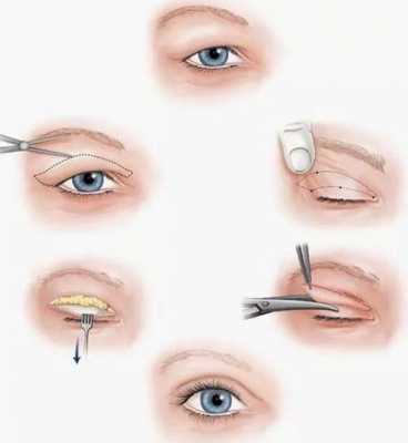 下肢眼皮手术过程（下眼睑切皮手术）-图1