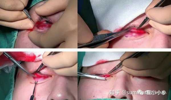 下肢眼皮手术过程（下眼睑切皮手术）-图2