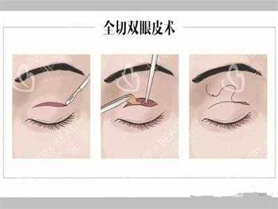 下肢眼皮手术过程（下眼睑切皮手术）-图3