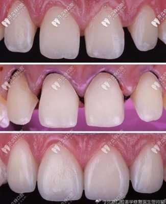 门牙贴面的过程（门牙贴面的过程是什么）-图3