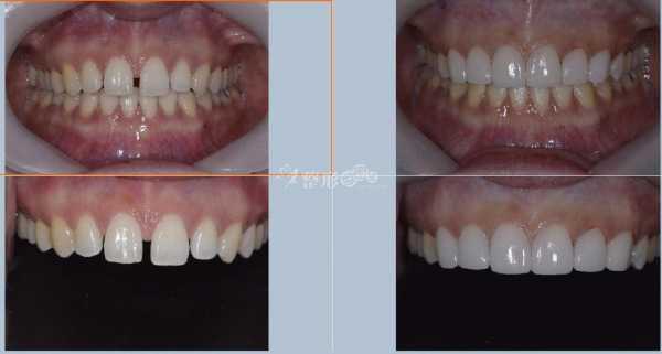 门牙贴面的过程（门牙贴面的过程是什么）-图2