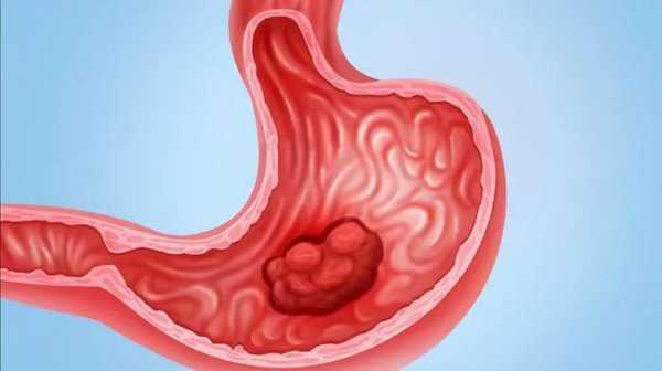 胃癌的形成过程（胃癌形成过程视频）-图3