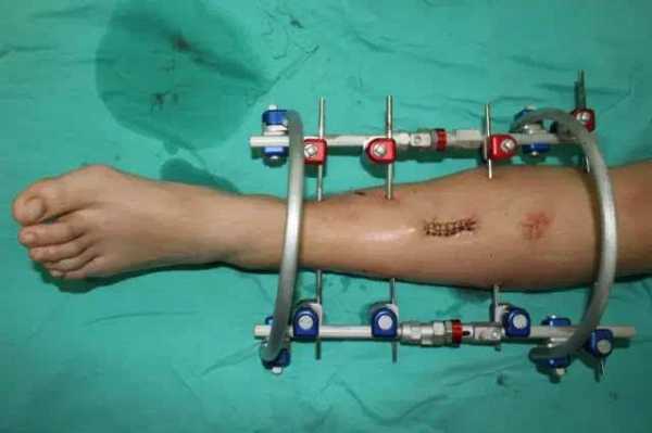 小腿骨折手术过程（小腿骨折手术全过程）-图3