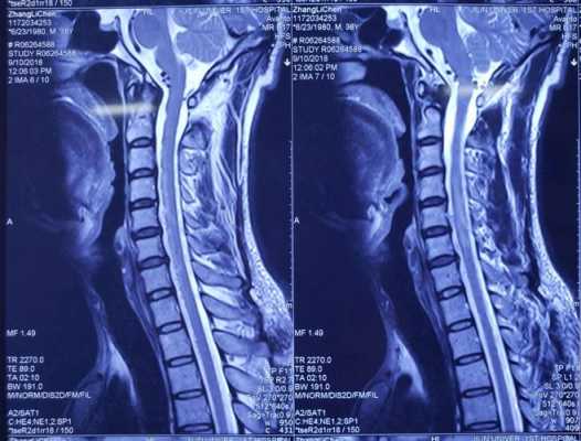 脊髓造影过程（脊髓造影过程图片）-图2