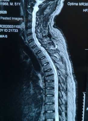 脊髓造影过程（脊髓造影过程图片）-图1