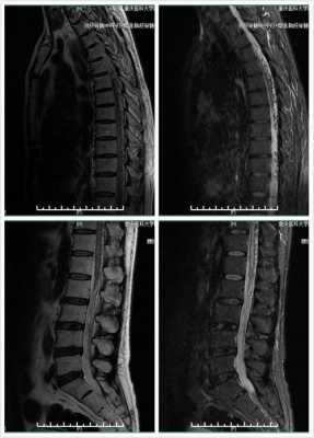 脊髓造影过程（脊髓造影过程图片）-图3