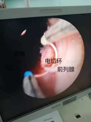 前列腺手术全过程视频（前列腺手术过程演示）-图1