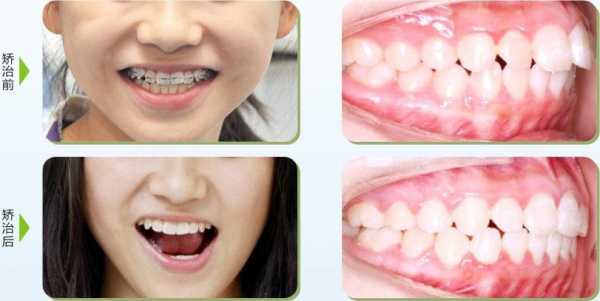 牙齿矫正的过程图片（牙齿矫正的过程会出现什么问题）-图3