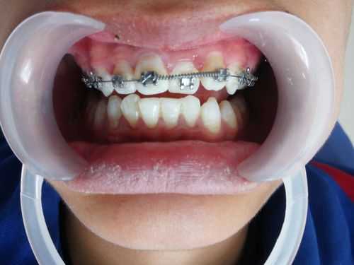 牙齿矫正的过程图片（牙齿矫正的过程会出现什么问题）-图1