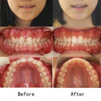 牙齿矫正的过程图片（牙齿矫正的过程会出现什么问题）-图2