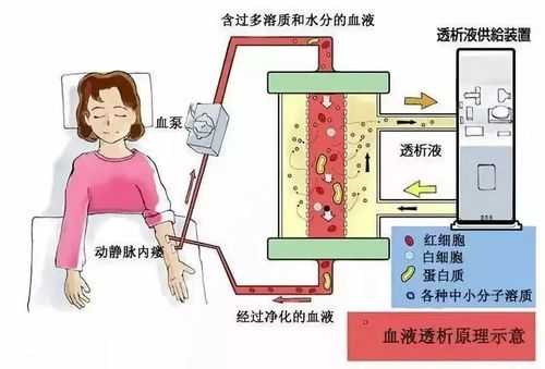 透析器过程（透析器工作原理图）-图3