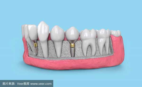 种植牙成型过程（种植牙的模型）-图2