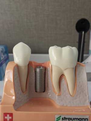 种植牙成型过程（种植牙的模型）-图1