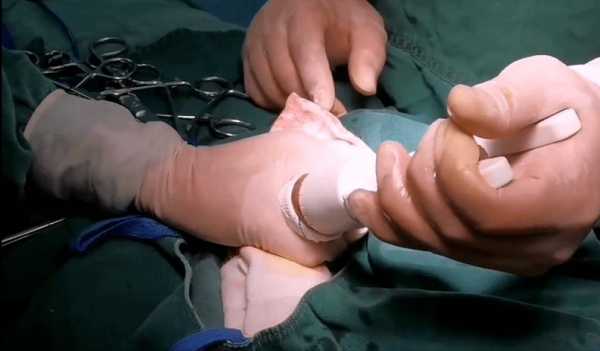 割包皮过程视频（割包皮视频 视频教程）-图1