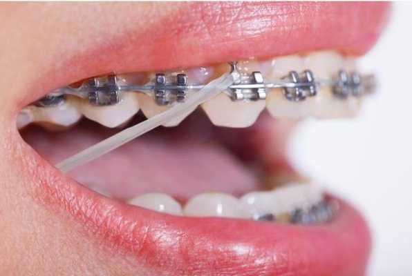牙齿矫正的过程（牙齿矫正的过程中牙齿会松动吗）-图2