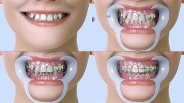 牙齿矫正的过程（牙齿矫正的过程中牙齿会松动吗）-图1