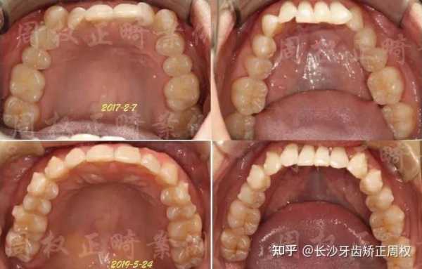 整牙的过程图（整牙的过程图解）-图2