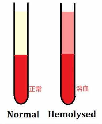 冷热溶血实验过程（热溶血试验阳性）-图1