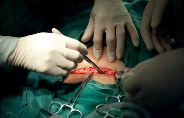 孕妇剖腹产过程（孕妇剖腹产过程视频播放）-图3