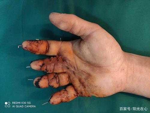 移植手指康复过程（移植手波）-图3