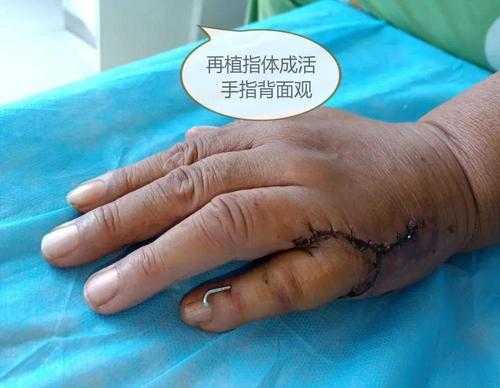 移植手指康复过程（移植手波）-图1
