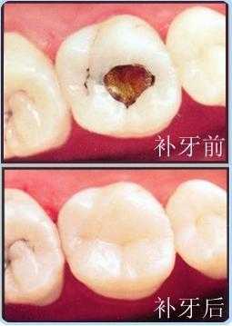 补牙过程洗牙（补牙洗牙疼不疼）-图2
