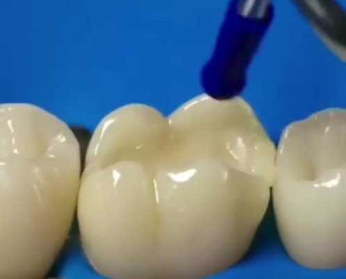 补牙过程洗牙（补牙洗牙疼不疼）-图3