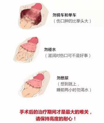 减包皮的过程（包皮怎么割除）-图3