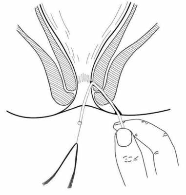 肛瘘挂线手术过程（肛瘘挂线手术全过程）-图3