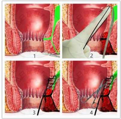 肛瘘挂线手术过程（肛瘘挂线手术全过程）-图1