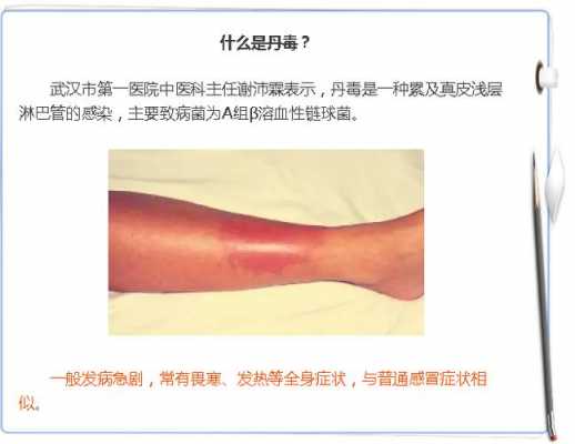 下肢丹毒痊愈过程（下肢丹毒的治疗周期）-图2