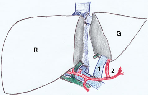 断流术过程（断流术的主要缺点）-图3
